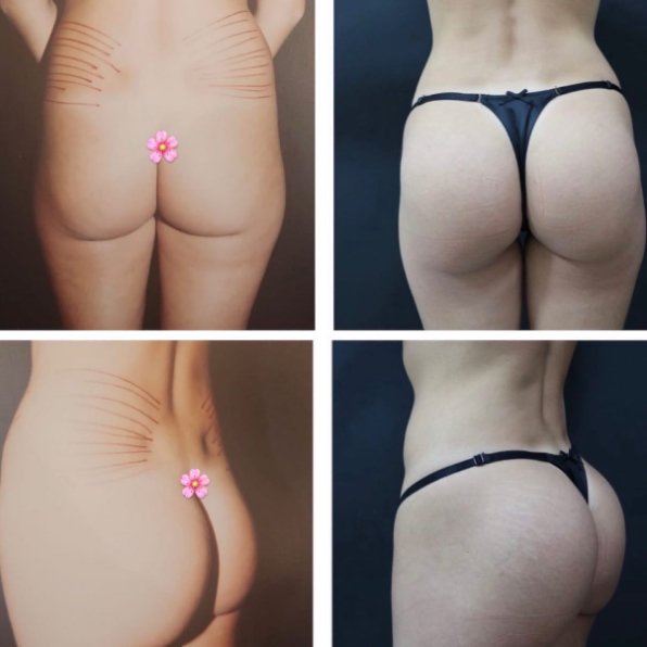 Gluteoplastia